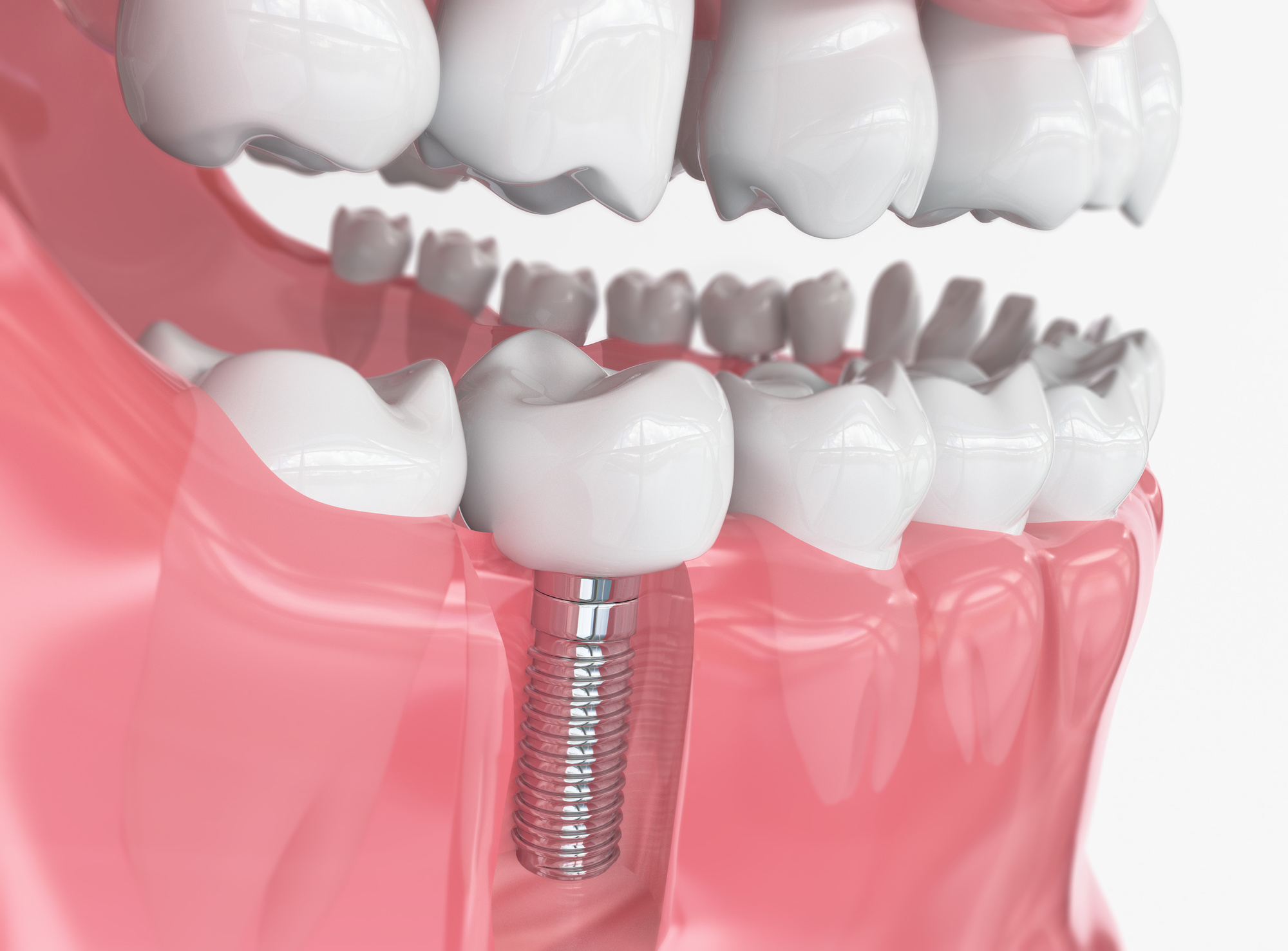  A 3D illustration of different types of permanent implants for cosmetic purposes such as crowns, bridges, and veneers.