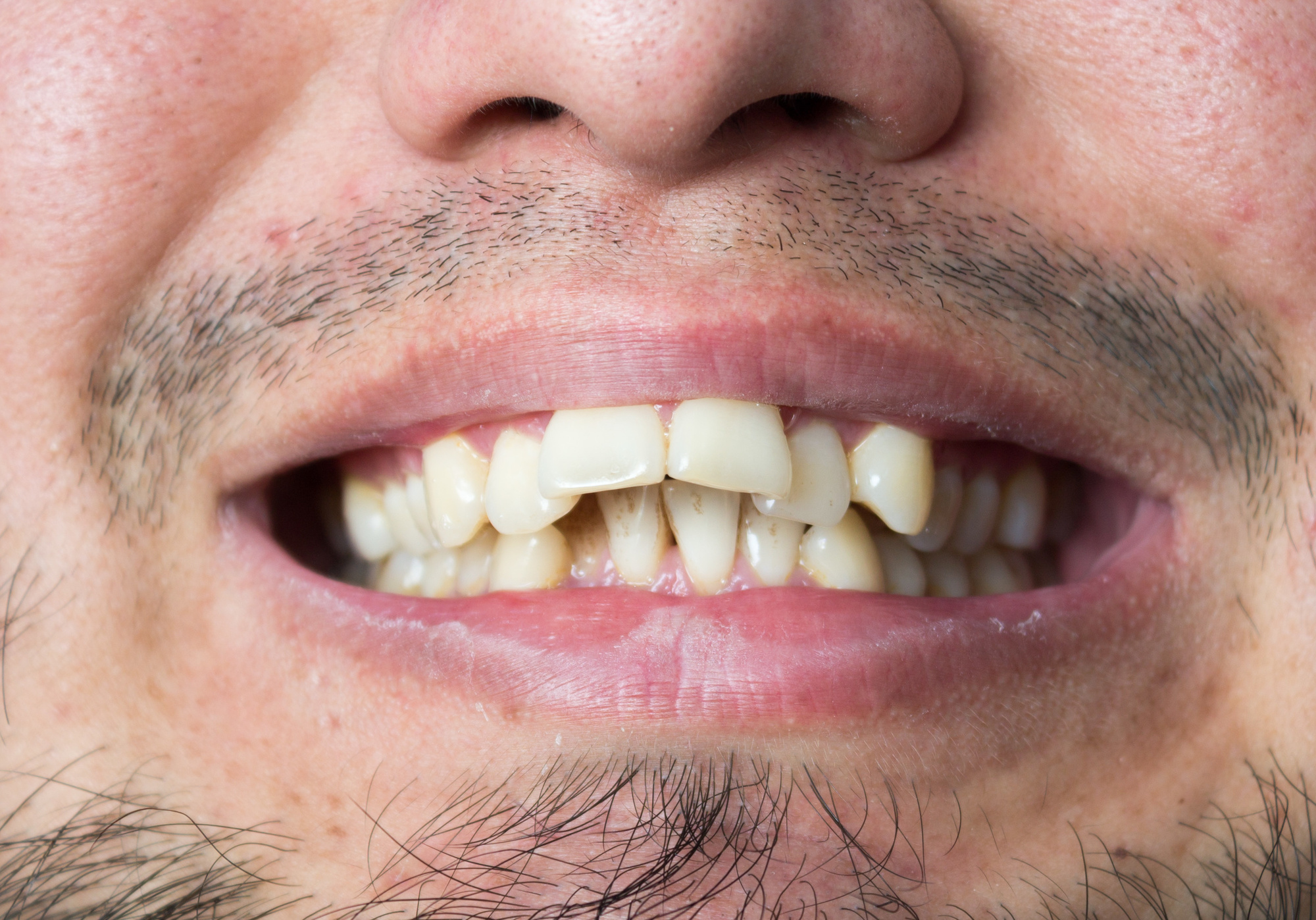 Do Invisalign Invisible Aligners Really Work as well as