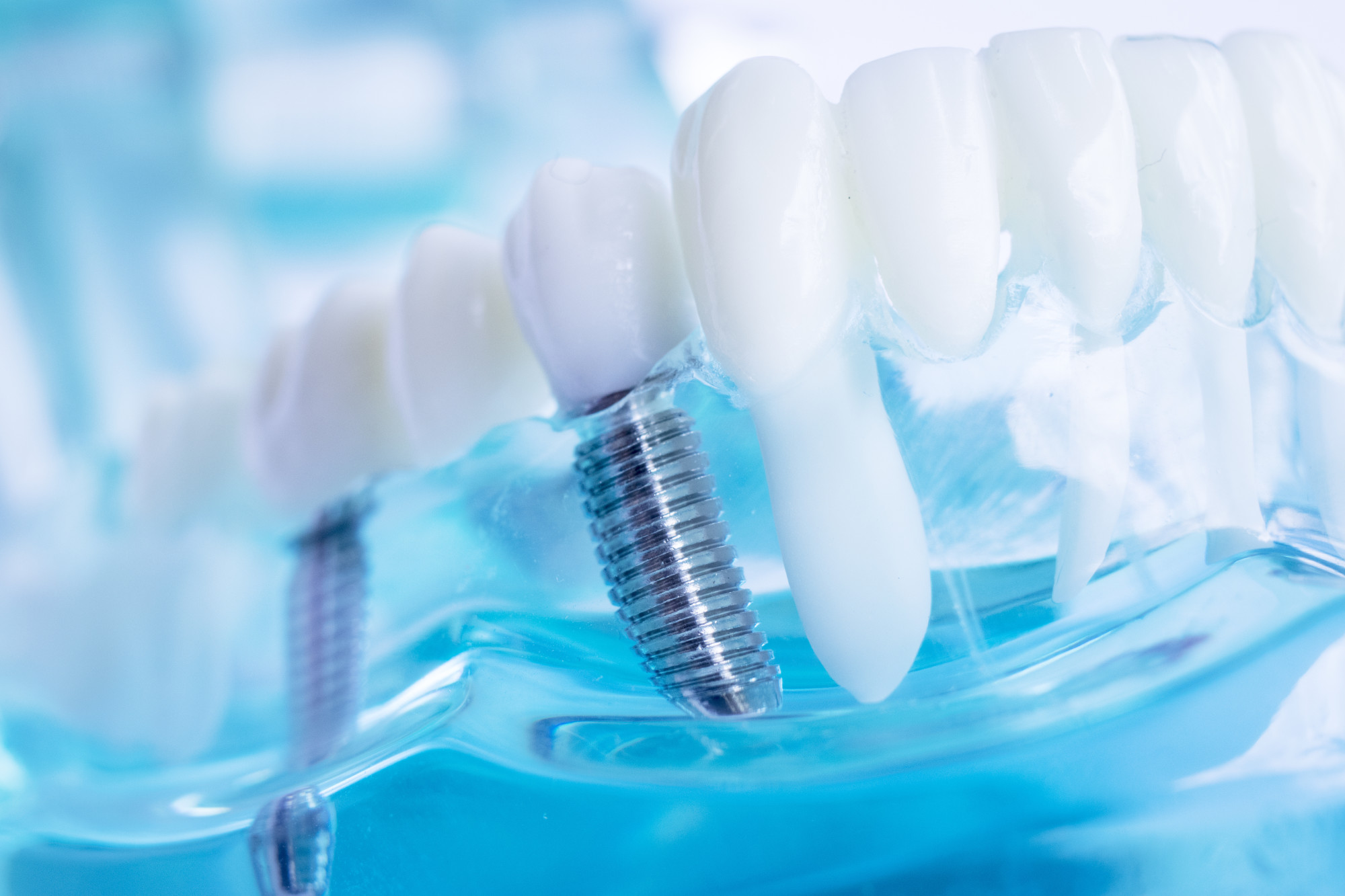 cigna-now-covering-the-cost-of-your-dental-care-implants-pro-center