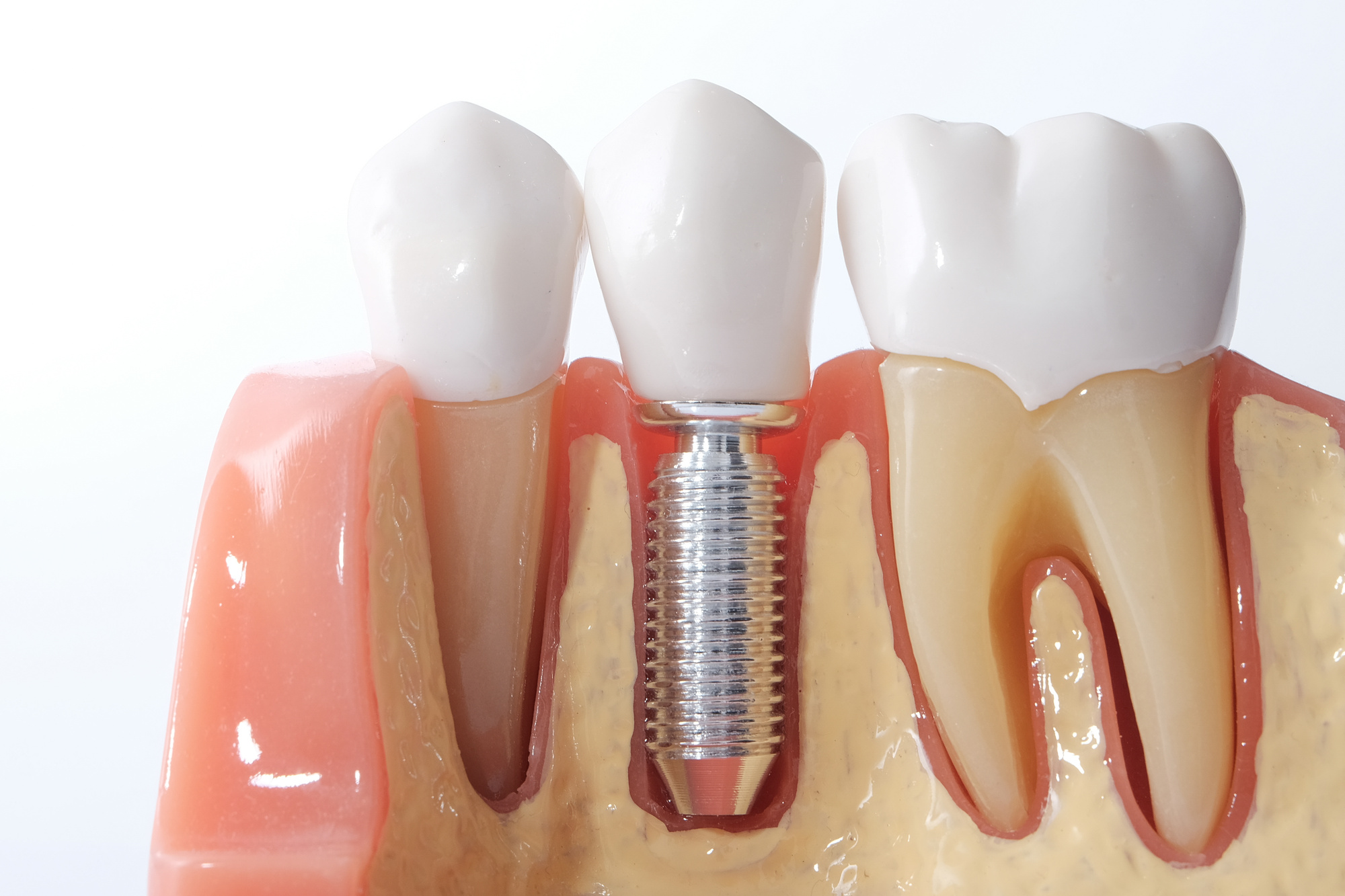 7-factors-to-consider-before-getting-dental-implants