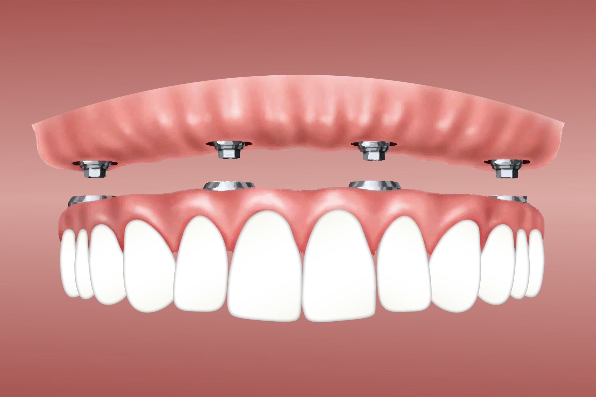 Dental Implant Vs Bridge