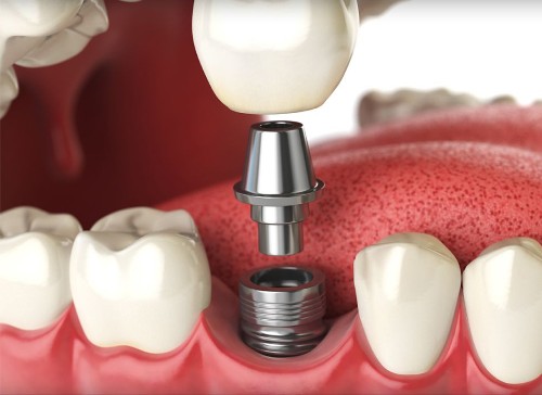 Dental Implants